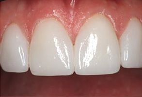 Today s Dentistry San Jose | Veneers, Dental Bridges and Invisalign reg